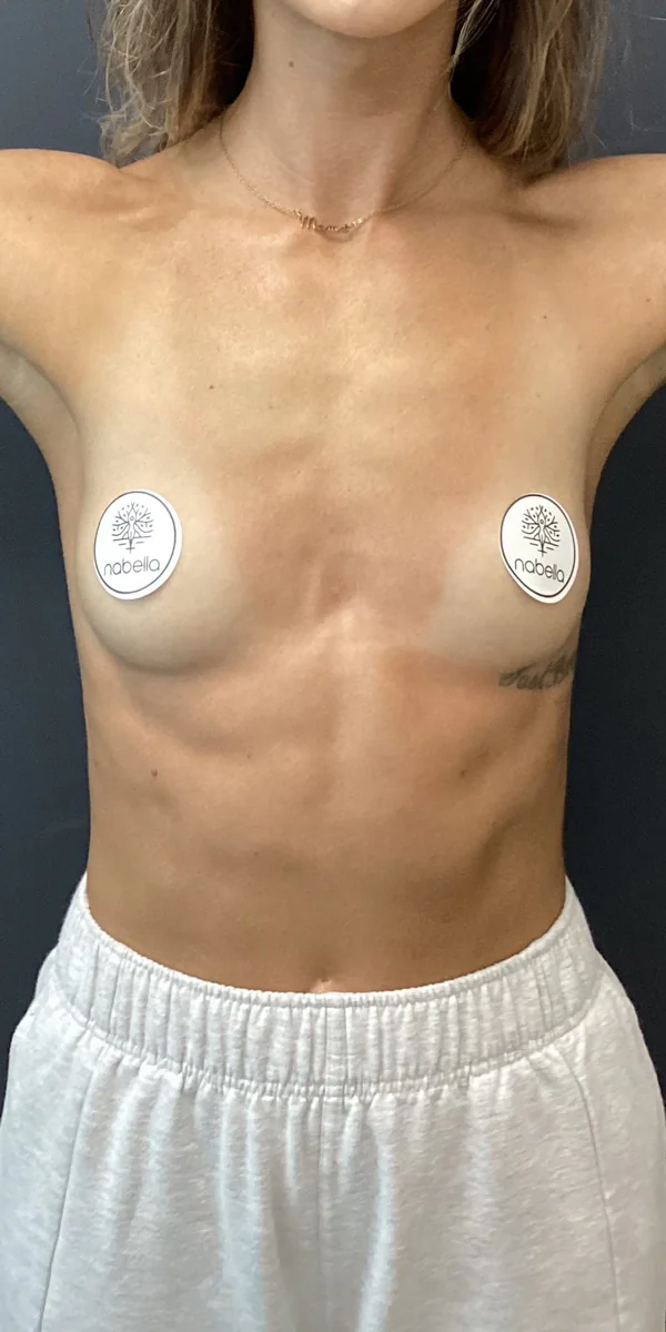 Before-Breast Before-Breast